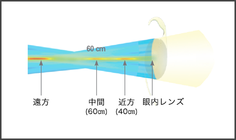 多焦点眼内レンズ